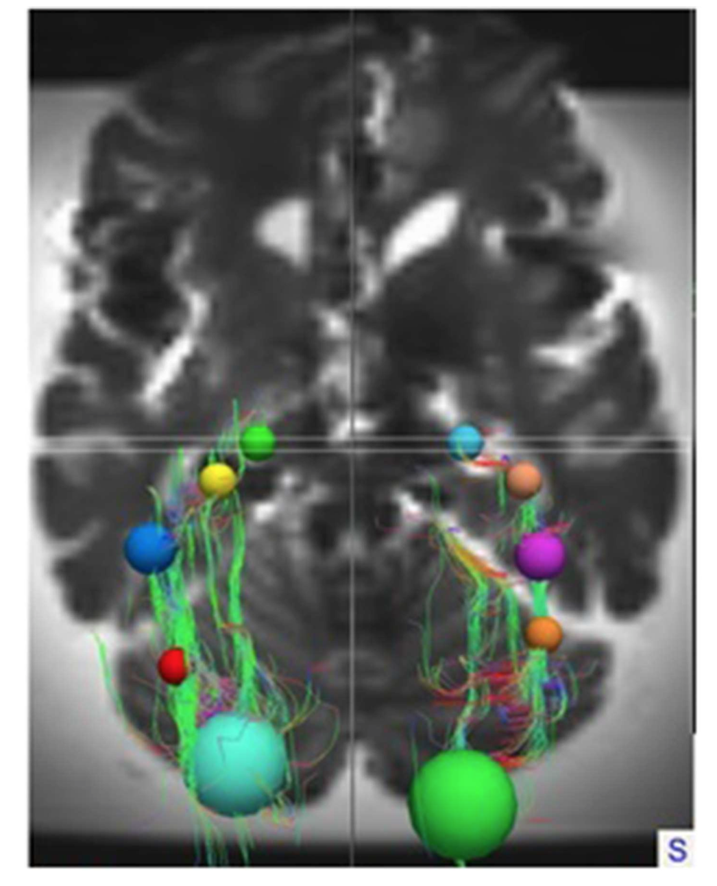 Preservation of the optic radiations based on comparative analysis of diffusion tensor imaging tractography and anatomical dissection