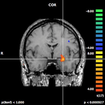 Amygdala guides feature-based attention