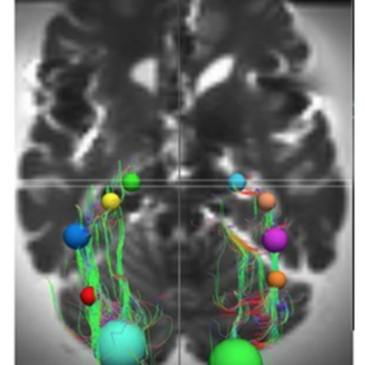 Preservation of the optic radiations based on comparative analysis of diffusion tensor imaging tractography and anatomical dissection